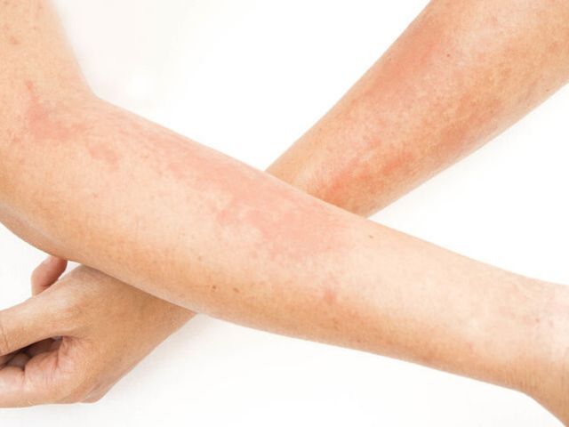 Detail Gambar Penyakit Dermatitis Kontak Nomer 9