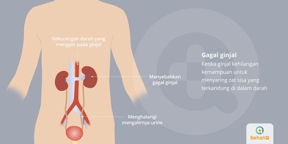 Detail Gambar Penyakit Gagal Ginjal Nomer 13