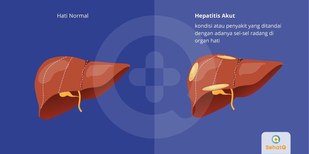 Detail Gambar Penyakit Hepatitis Nomer 28