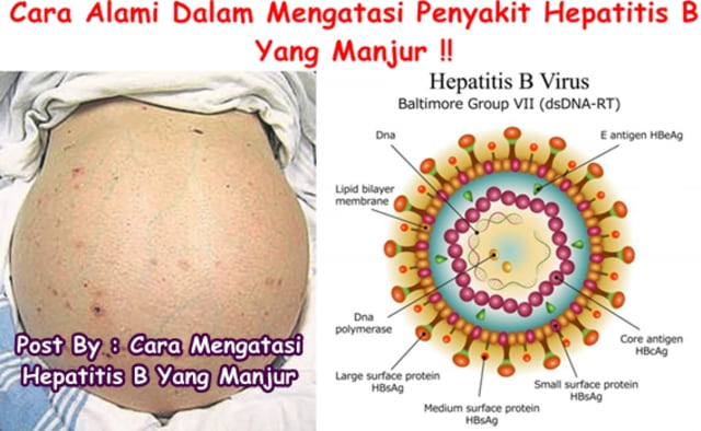 Detail Gambar Penyakit Hepatitis Nomer 40