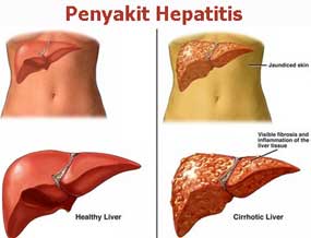 Detail Gambar Penyakit Hepatitis Nomer 45