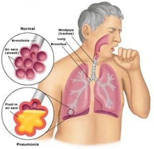 Detail Gambar Penyakit Pernafasan Manusia Nomer 2