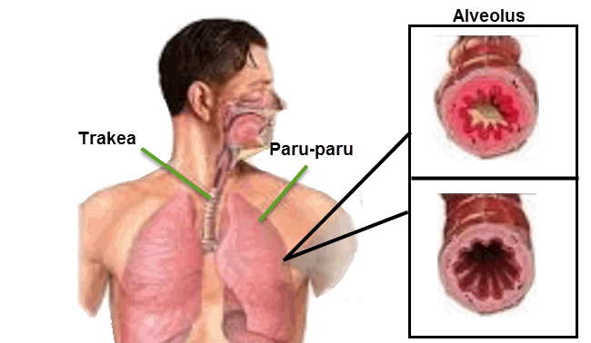 Detail Gambar Penyakit Pernafasan Manusia Nomer 11