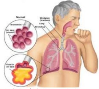 Detail Gambar Penyakit Pernafasan Manusia Serta Keterangannya Nomer 5