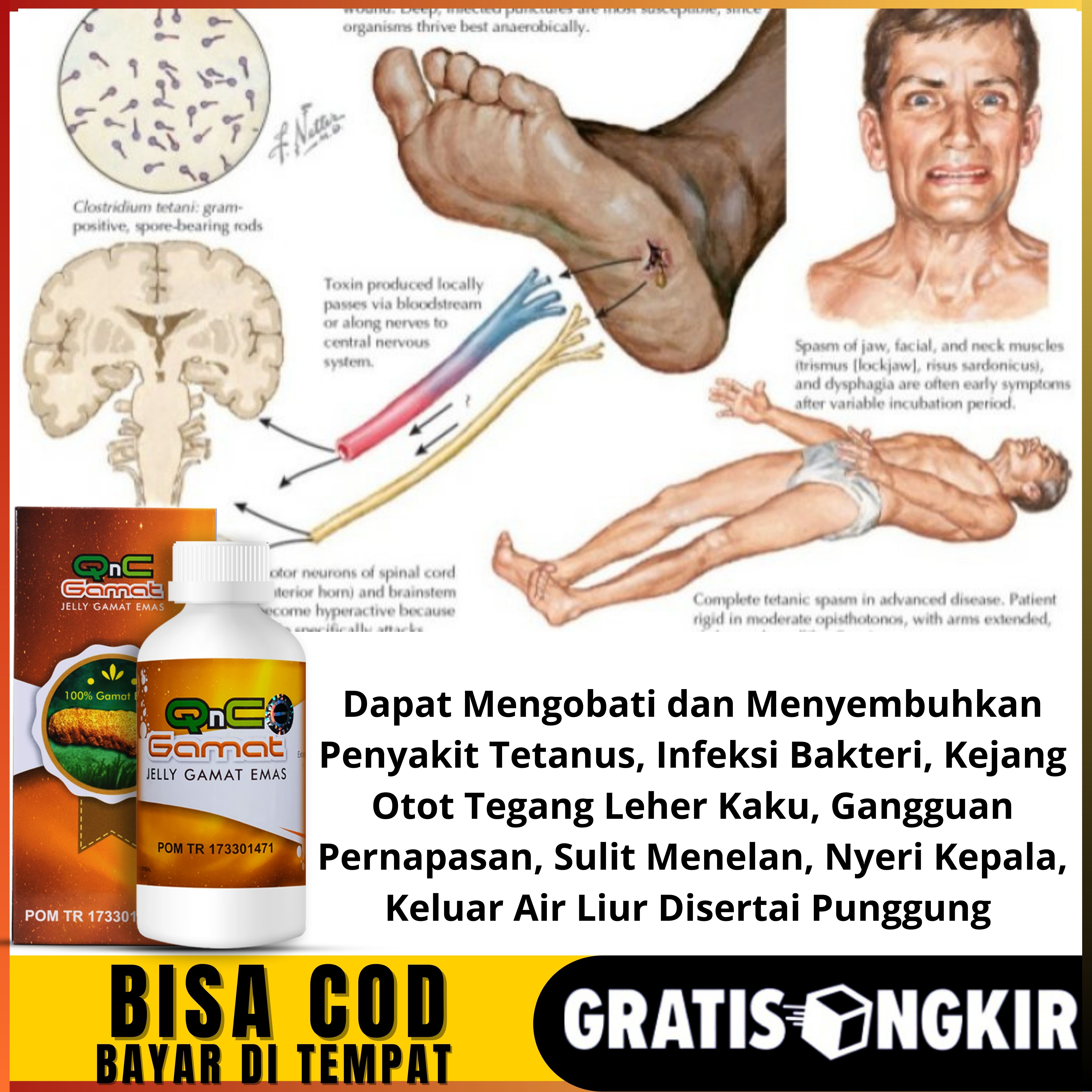 Detail Gambar Penyakit Tetanus Nomer 8