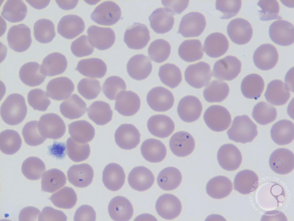 Detail Gambar Plasmodium Falciparum Nomer 13