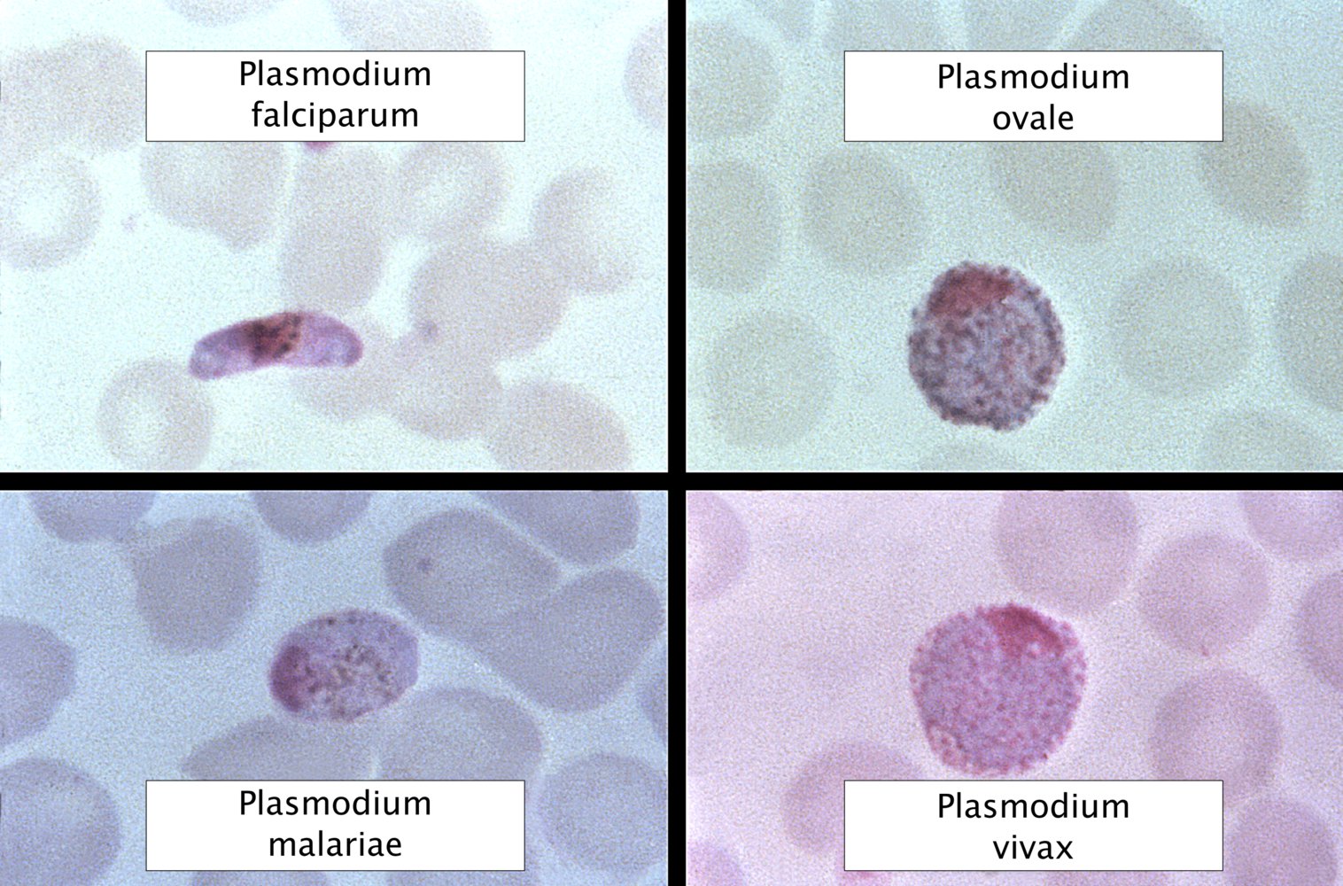 Detail Gambar Plasmodium Falciparum Nomer 22