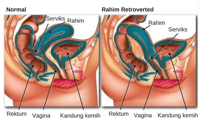 Detail Gambar Rahim Manusia Nomer 16