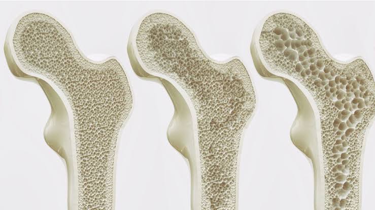 Detail Gambar Suplemen Untuk Osteoporosis Nomer 29
