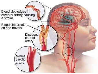 Detail Gambar Titik Syaraf Stroke Nomer 2