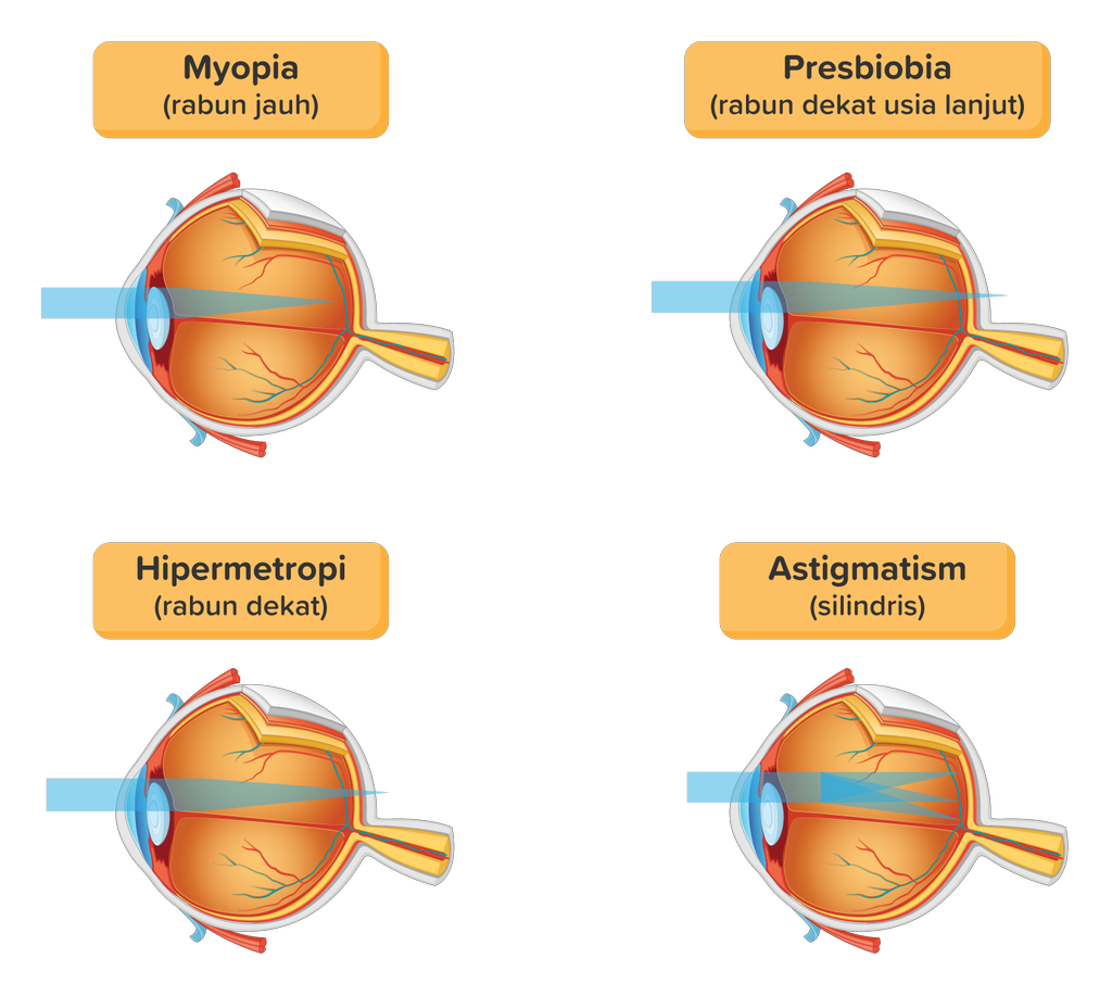 Gangguan Pada Mata Beserta Gambar - KibrisPDR