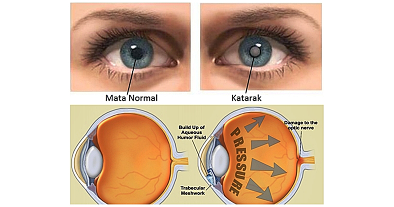 Detail Gangguan Pada Mata Beserta Gambar Nomer 3