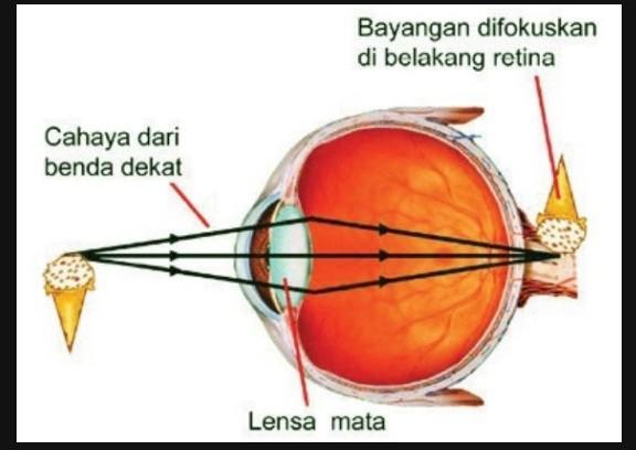 Detail Gangguan Pada Mata Beserta Gambar Nomer 17