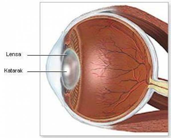Detail Gangguan Pada Mata Beserta Gambar Nomer 30