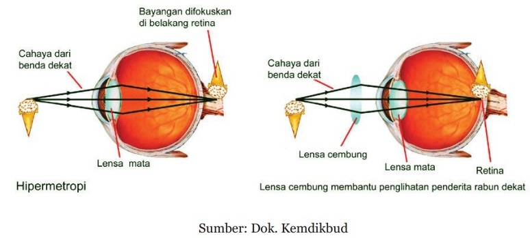 Detail Gangguan Pada Mata Beserta Gambar Nomer 4