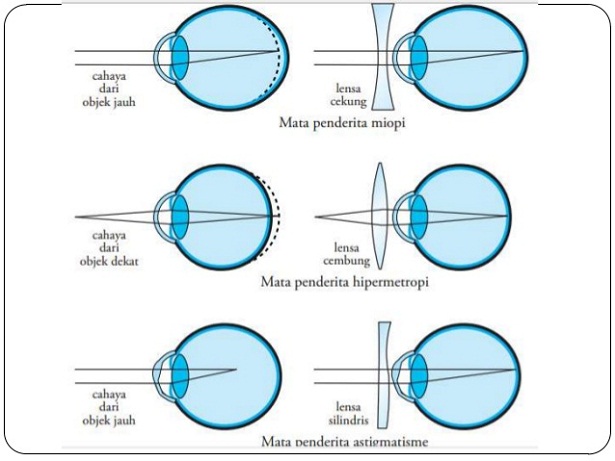 Detail Gangguan Pada Mata Beserta Gambar Nomer 6