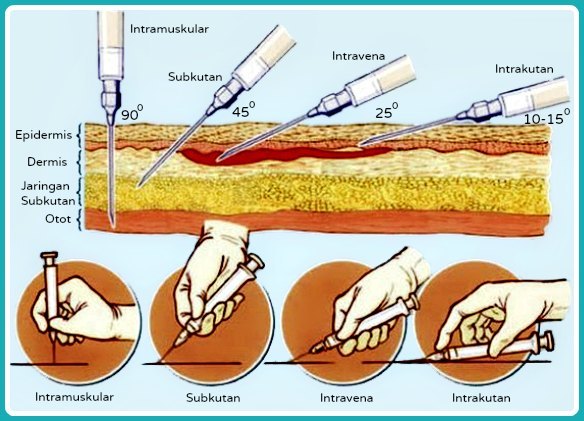 Detail Injeksi Subkutan Adalah Nomer 3