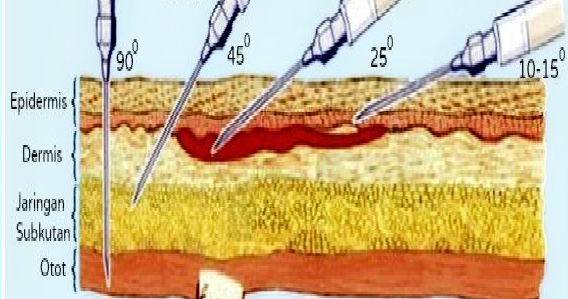 Detail Injeksi Subkutan Adalah Nomer 27