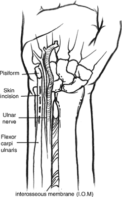 Detail M Flexor Carpi Ulnaris Nomer 4