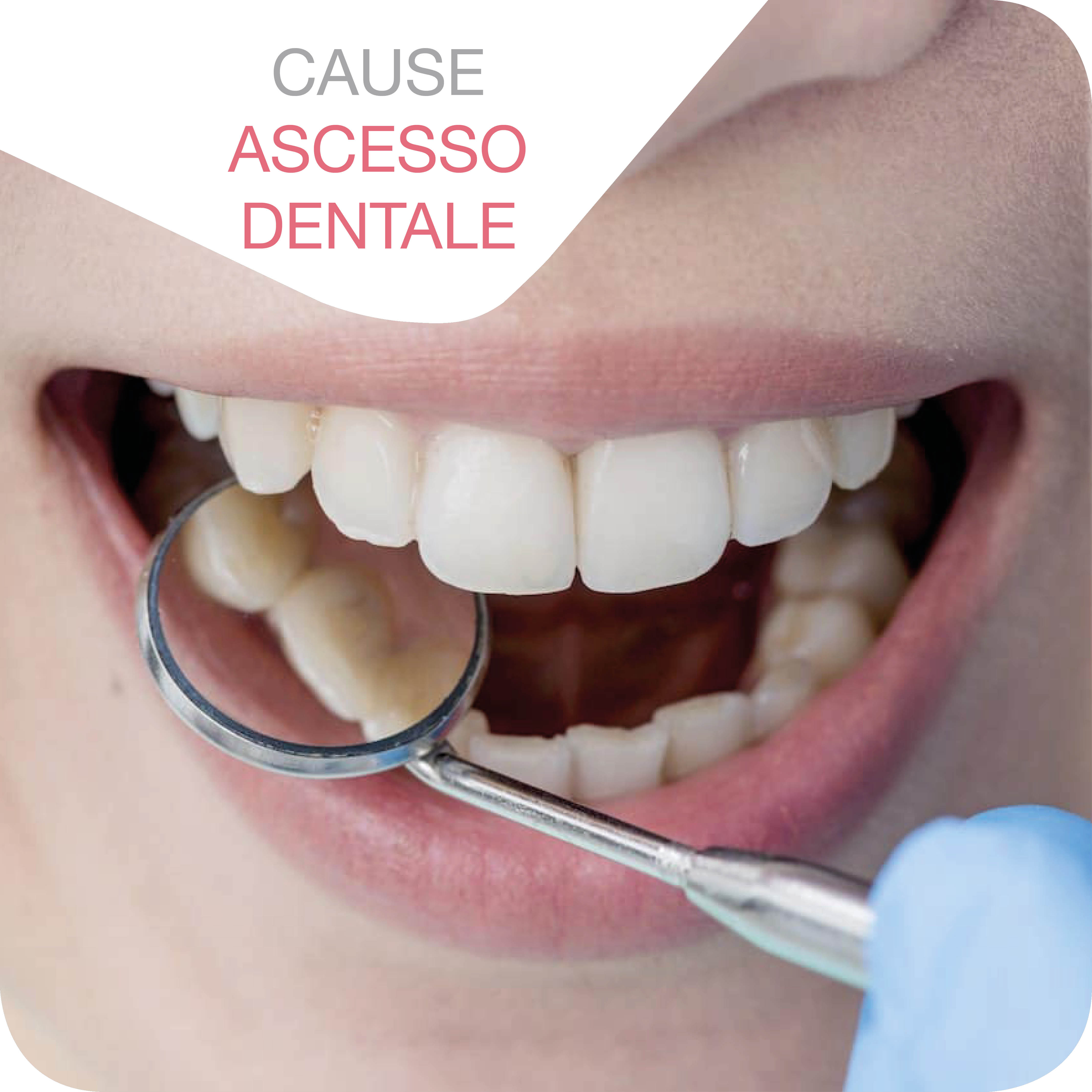 Detail Foto Ascesso Dentale Nomer 8