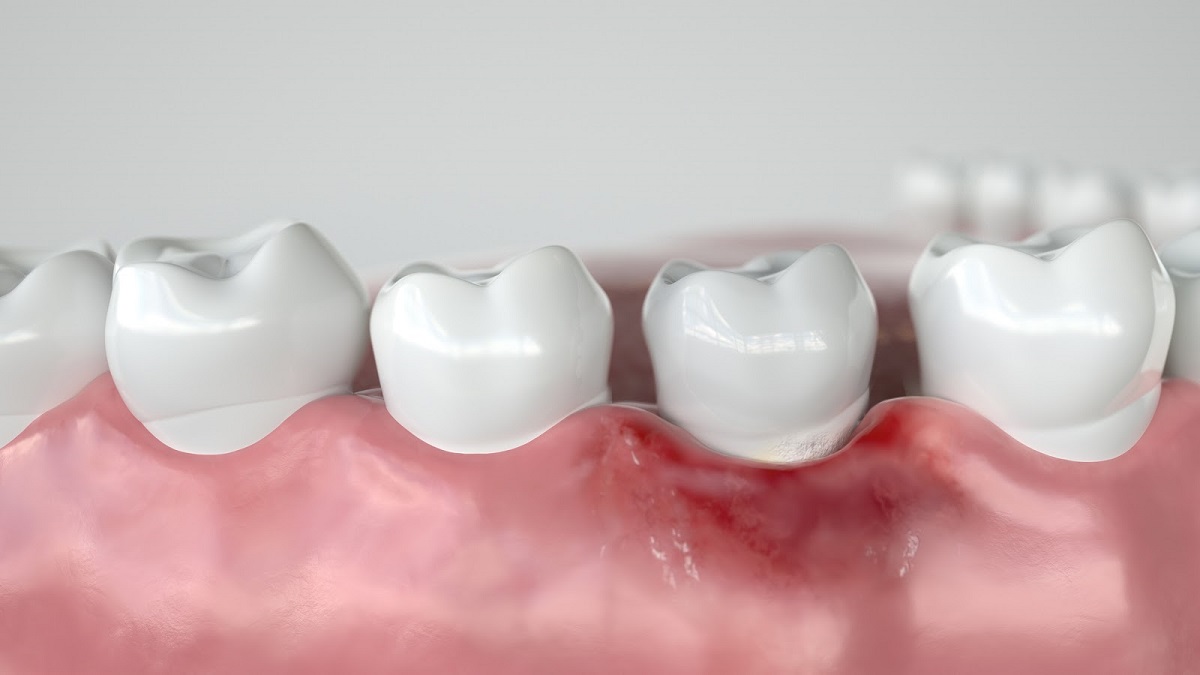 Detail Foto Ascesso Dentale Nomer 17