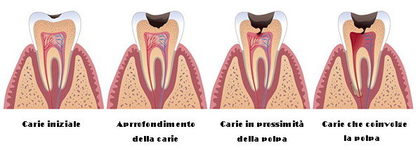 Detail Foto Ascesso Dentale Nomer 21