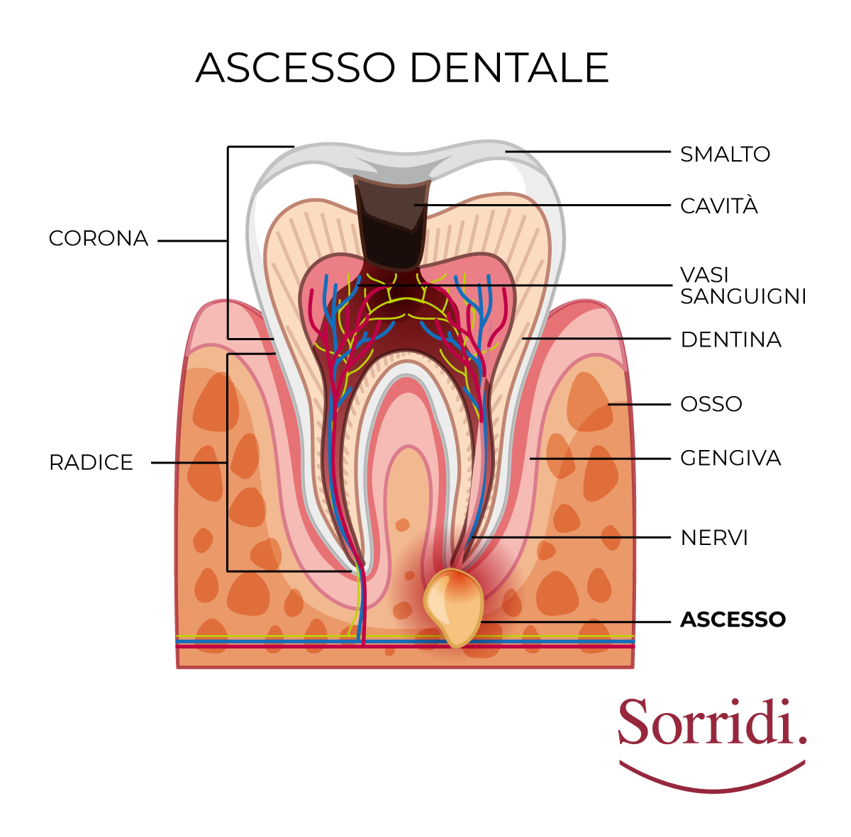 Detail Foto Ascesso Dentale Nomer 6