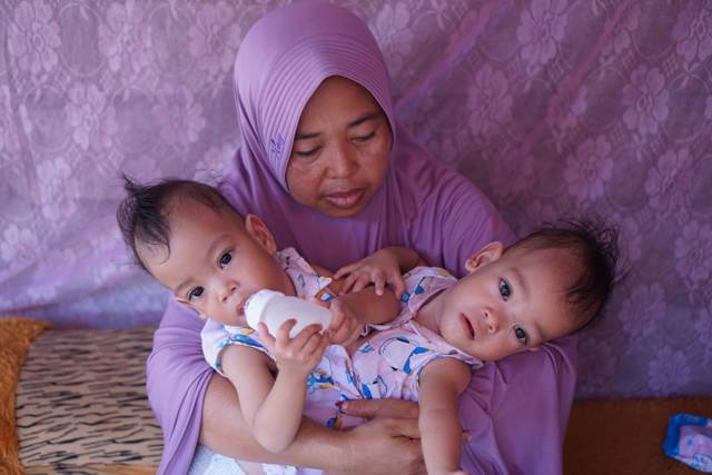 Detail Foto Bayi Kembar Siam Nomer 13