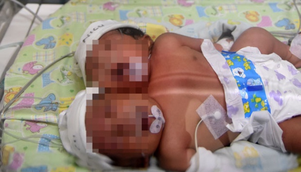 Detail Foto Bayi Kembar Siam Nomer 35