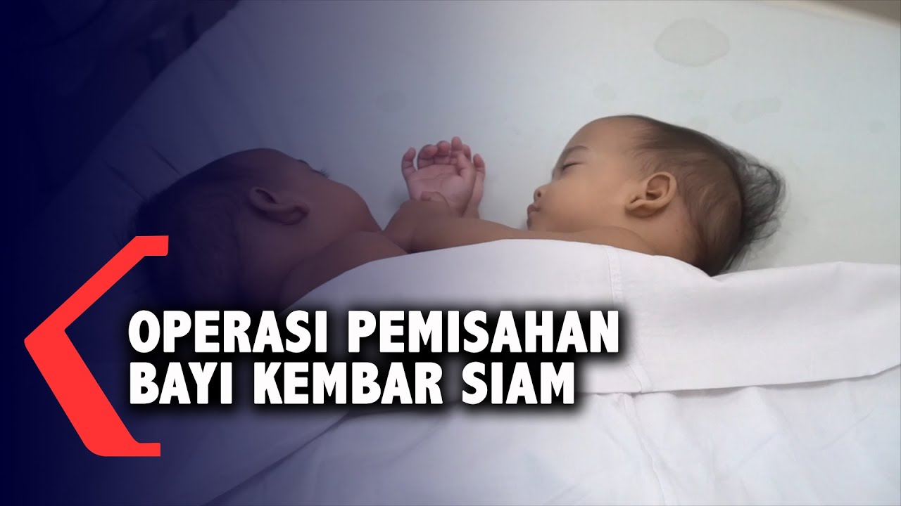 Detail Foto Bayi Kembar Siam Nomer 56