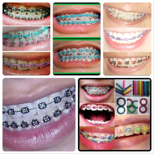 Detail Foto Behel Gigi Nomer 30