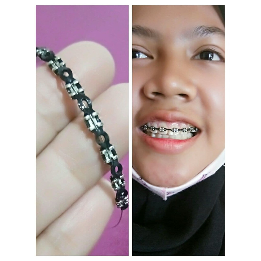 Detail Foto Behel Karet Nomer 18