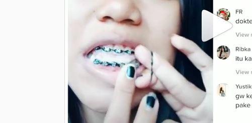 Detail Foto Behel Karet Nomer 34