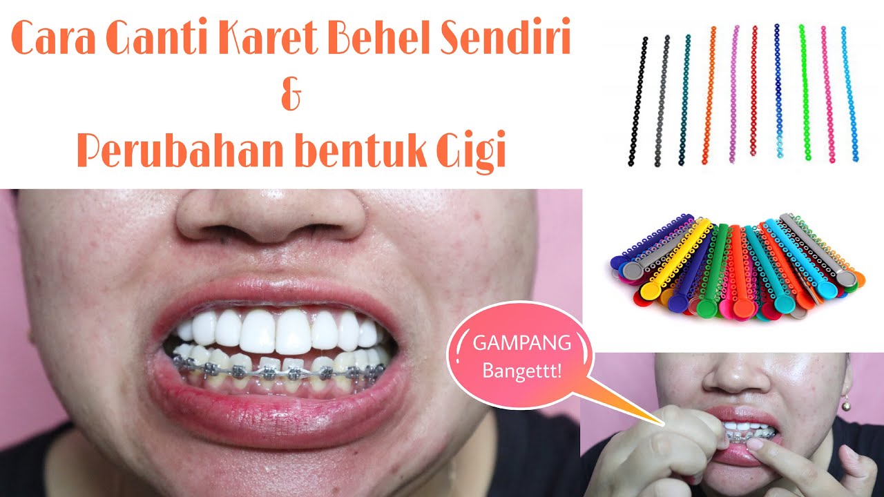 Detail Foto Behel Karet Nomer 46