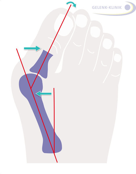 Detail Hallux Valgus Bilder Nomer 3