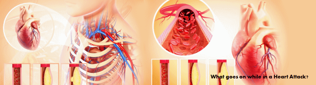 Detail Heart Attack Animated Gif Nomer 56