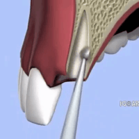 Detail Implant Gif Nomer 6