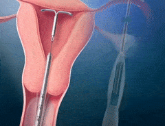 Insertion Gif - KibrisPDR