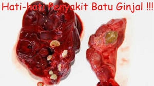 Detail Batu Ginjal Gambar Nomer 22