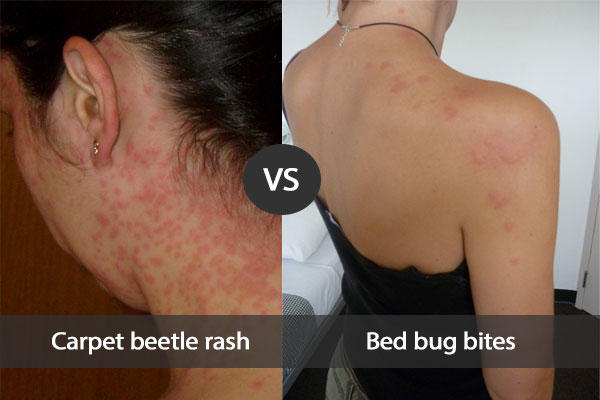 Detail Bed Bug Rashes Images Nomer 27