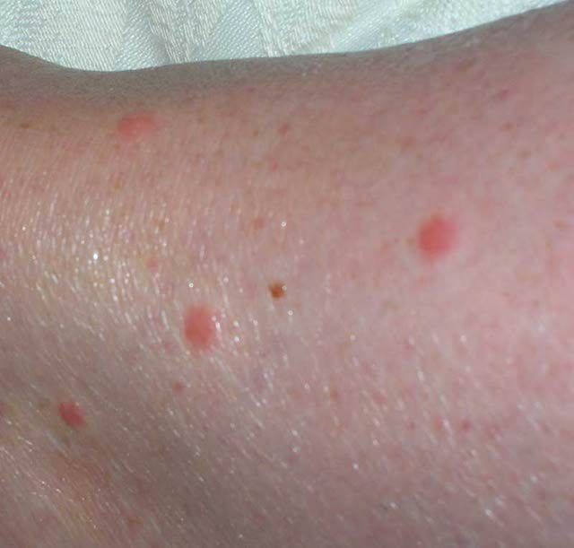 Detail Bed Bug Rashes Images Nomer 33