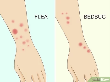 Detail Bed Bug Rashes Images Nomer 6