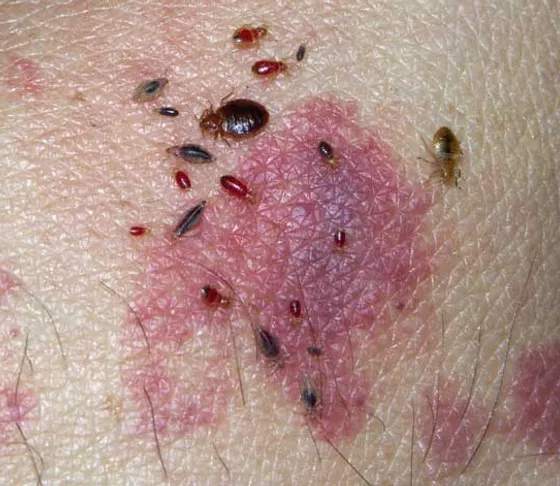Detail Bed Bugs Image Gallery Nomer 33
