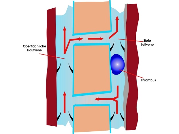 Detail Thrombose Bilder Nomer 14