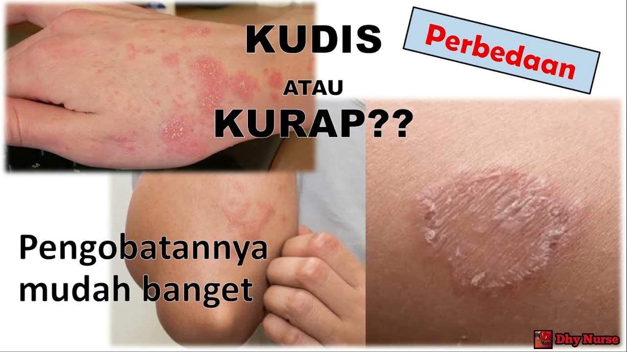 Detail Foto Kudis Dan Kurap Nomer 2