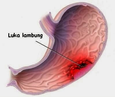 Detail Foto Lambung Luka Nomer 2