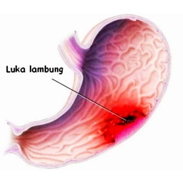 Detail Foto Lambung Luka Nomer 18