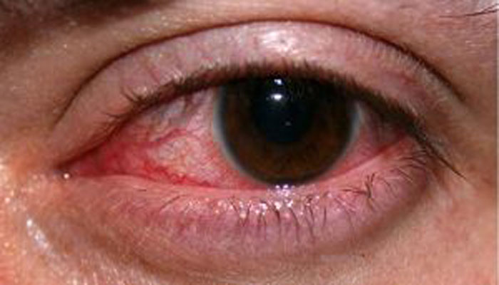 Detail Bercak Darah Di Mata Nomer 48