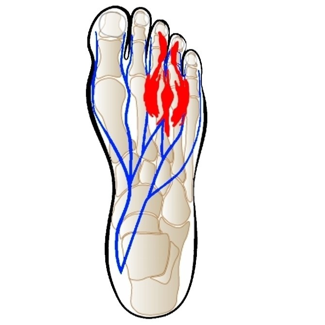 Detail Knie Hornhaut Nomer 26