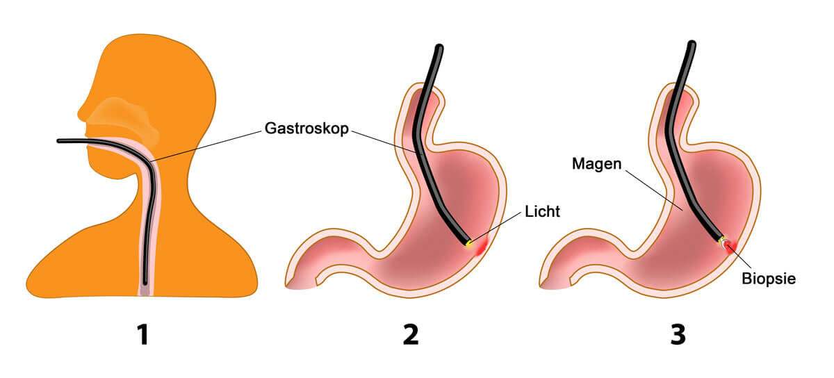 Gastroskopie Bilder - KibrisPDR